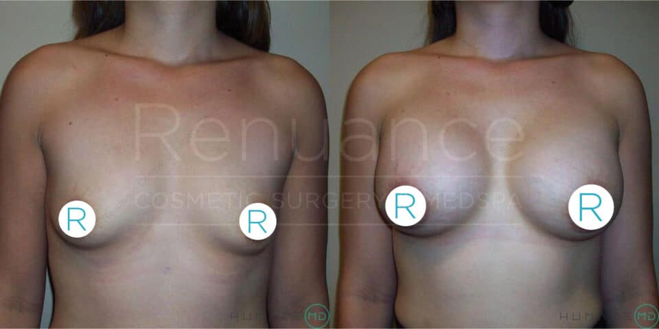 A before and after image showing the results of breast augmentation surgery. The left side displays a woman's chest with smaller and less pronounced breasts, while the right side shows the same woman with noticeably larger and fuller breasts. Both images include circular markers with the letter "R" on each breast, likely indicating the right side. The background text "Renuance COSMETIC SURGERY MED SPA" is faintly visible. The lighting and angle in both images appear consistent.