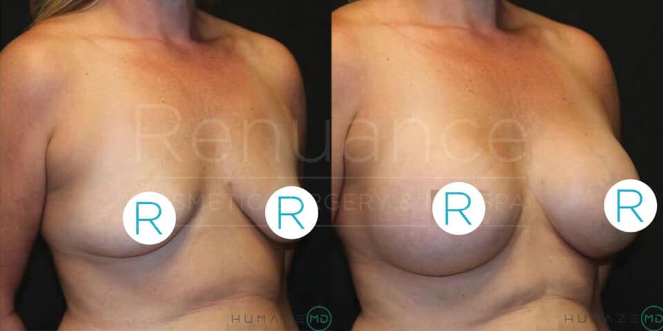 Before and after images of a woman's upper torso showcasing the results of a breast augmentation procedure. The left image shows the torso before the surgery with smaller breasts, while the right image shows the enhanced, fuller breasts after the surgery. The background is dark, and the logos of Renuance Cosmetic Surgery & Medical Spa are faintly visible. Translucent circles with an "R" are overlaid on both images, covering the nipples for modesty.