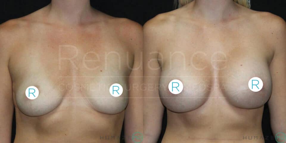 Two side-by-side images show a person's chest before and after breast augmentation surgery. The left image displays the chest prior to the procedure, while the right image illustrates the result afterwards, with visibly fuller and more symmetrical breasts. Both images are labeled with the letter "R" on each breast. The background includes a watermark with partially readable text, "Renuance Cosmetic Surgery."