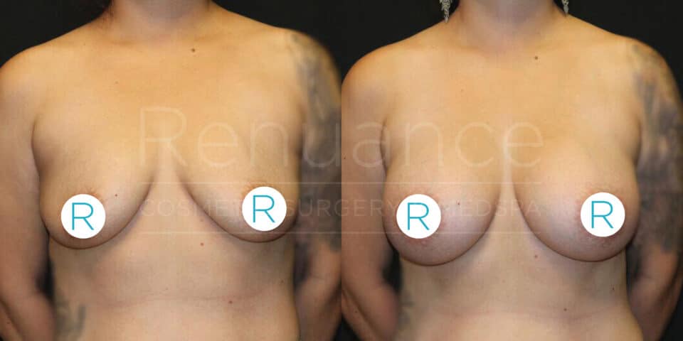 A side-by-side comparison photo of a person's chest before and after breast augmentation surgery. Both images show the torso from the neck to the waist, with the nipples covered by circles marked with the letter "R". The left side shows the chest before surgery and the right side shows the chest after surgery, with visible changes in the contour and size of the breasts. The background is a neutral, dark color.