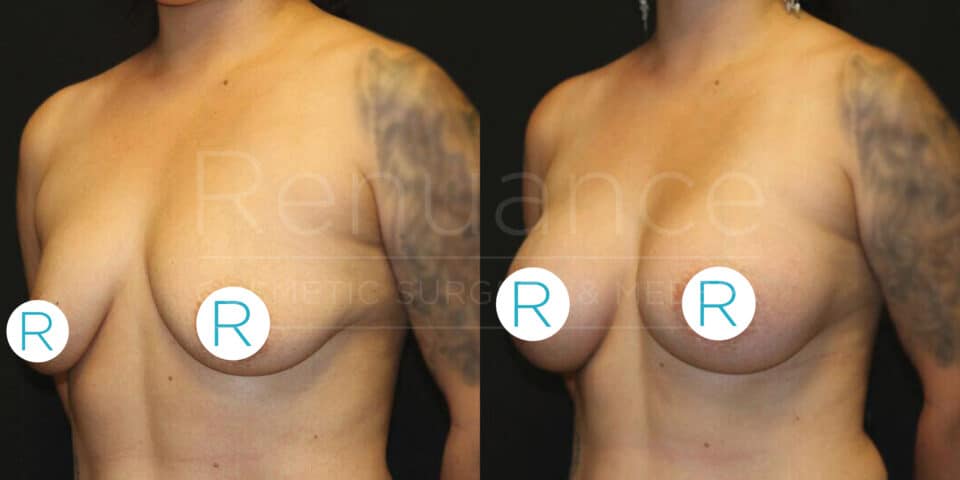 A side-by-side comparison image showing the same person before and after breast augmentation surgery. On the left, the person’s natural breast size is visible, while on the right, postoperative results show increased breast size and more lifted appearance. The person has a tattoo on the upper arm, visible in both images. The background is dark, and the images are watermarked with text that is partially visible.
