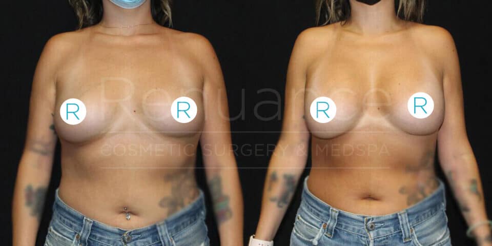 Before and after comparison image showing a woman's torso with breast augmentation. The left side depicts the woman before surgery, displaying smaller breasts, while the right side shows the postoperative result with larger breasts. Both images show the woman topless, wearing only jeans, and some tattoos are visible on her arms and torso. The nipples are covered with circular stickers labeled "R".