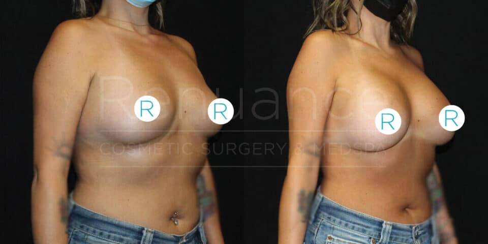 Two side-by-side images showing a woman's upper body before and after breast augmentation surgery. In both images, the woman is standing slightly turned to the side, wearing jeans and a mask. Her breasts are marked with circles containing the letter "R" on each breast to cover the nipples. The left image shows the breasts before augmentation, and the right image shows the breasts after the procedure, appearing larger and fuller. The text "Cosmetic Surgery & Med Spa" is faintly visible in the background.