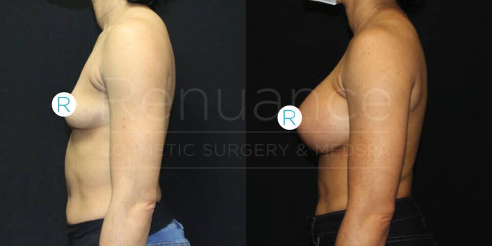 Side-by-side comparison image of the torso of a woman before and after a cosmetic surgery procedure showing increased breast size.