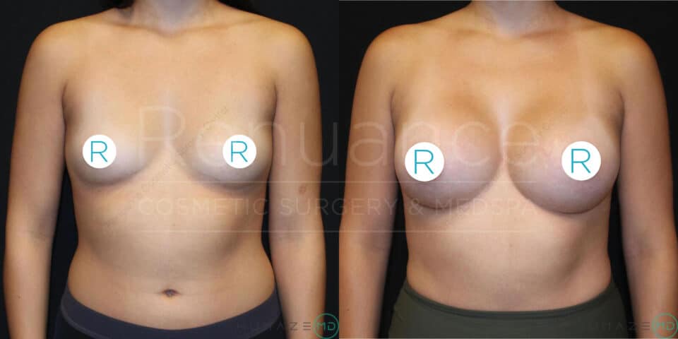 Side-by-side comparison of a woman's chest before and after breast augmentation surgery. The left side shows the "before" image with smaller, natural breasts, while the right side shows the "after" image with larger, more rounded breasts. Both images have circular markers labeled "R" placed over the nipple area. The background is black with faint text that appears to read "Resuance COSMETIC SURGERY & MEDSPA."