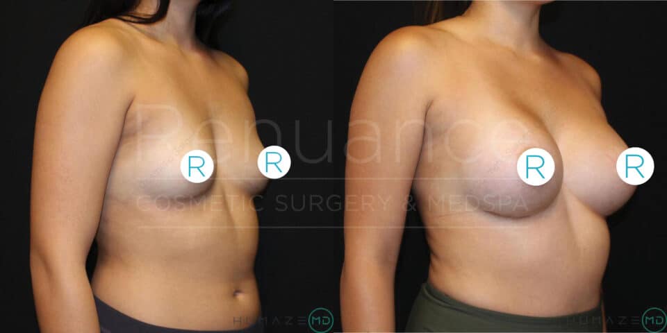 Two side-by-side images show the same woman before and after breast augmentation surgery. The left image is the "before" photo, featuring a side view of the woman with smaller breasts. The right image is the "after" photo, showcasing a side view with larger, enhanced breasts. The woman is wearing a dark-colored top in both photos. The background in both images is solid black, and there is text in the middle that reads, "Revance Cosmetic Surgery & MedSpa."