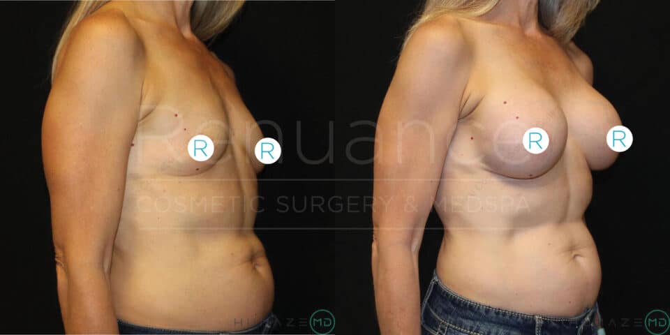 Two side-by-side images of a woman's torso, showing before-and-after results of a cosmetic procedure. In the left image, the woman's breasts are smaller and less protruding. In the right image, her breasts are larger and more defined. She is wearing jeans, and both images have "R" stickers covering her nipples. The background is black, and there is text on the image that reads "Bouzan Cosmetic Surgery & Medspa."