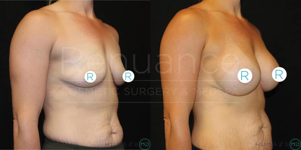 A side-by-side comparison of a woman's torso showing before and after breast augmentation surgery. The "before" image on the left depicts smaller breasts, while the "after" image on the right shows larger, fuller breasts. Both images are covered at the nipples with circular "R" stickers. The image includes a watermark for "Rejuance Cosmetic Surgery & Med Spa."
