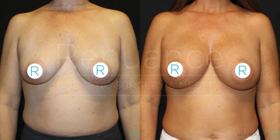 A side-by-side comparison of a woman's torso is shown, before and after breast augmentation surgery. The left image shows the torso before surgery, with a blue circle labeled "R" on each breast. The right image shows the torso after surgery, with noticeable changes to the shape and size of the breasts, and the same blue circles with "R" on them. The background is black, and the images appear to be taken in a clinical setting. Text indicating "Renuance Cosmetic Surgery & Med
