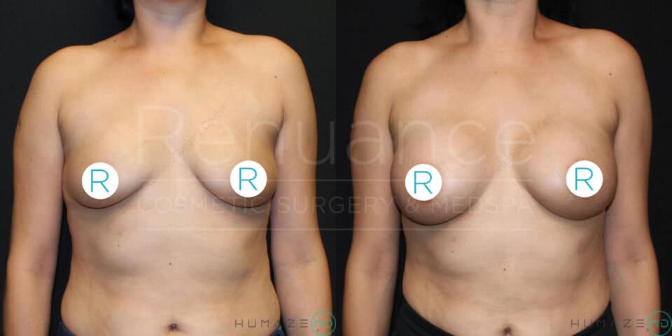 A before-and-after image of a woman showing the results of breast augmentation or lift surgery. On the left, the woman's breasts appear saggy and lower in position, while on the right, her breasts are lifted and fuller. The nipples are covered with "R" stickers in both images. The background is black, highlighting the changes in the subject's appearance.