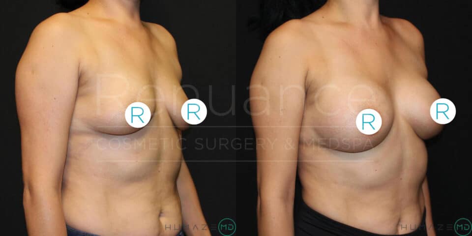A side-by-side comparison image shows a woman's upper body before and after breast augmentation surgery. The left side of the image displays the "before" photo, where the woman's chest appears flatter. The right side displays the "after" photo, where the woman's breasts are visibly fuller and more pronounced. Both images have circles labeled "R" placed on the woman's breasts for reference. The background in both images is dark. Text on the image reads "Remuance Cosmetic Surgery & MedSpa" with a