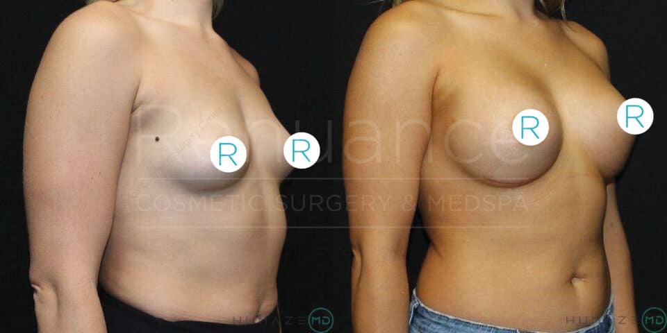 Two side-by-side images show a woman's upper torso before and after breast augmentation surgery. In the "before" image on the left, her breasts appear smaller and less firm. In the "after" image on the right, her breasts are noticeably larger and more rounded, indicating the results of the augmentation. Both images have black backgrounds and labels with the letter "R" covering the nipples for modesty. The text "Radiance Cosmetic Surgery & Medspa" and a circular logo are visible across both