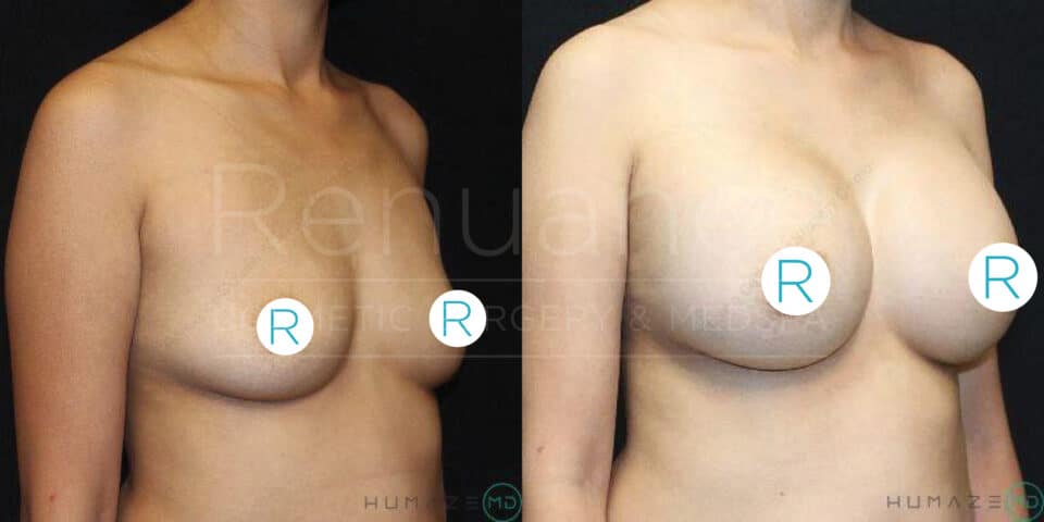 Before and after comparison image of a person who underwent breast augmentation surgery. The left side shows the pre-surgery state, where the breasts are smaller. The right side shows the post-surgery state, where the breasts are significantly larger and more prominent.