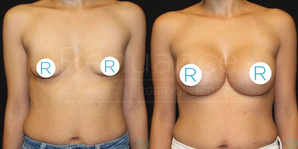 Two side-by-side images showing a before and after comparison of a person's chest. On the left is the "before" image displaying a person's chest with smaller breasts. On the right is the "after" image showing the same person's chest with noticeably larger breasts, indicating a breast augmentation procedure. The person is shown from the waist up, standing against a dark background. Each image has circular labels with the letter "R" covering the nipples.