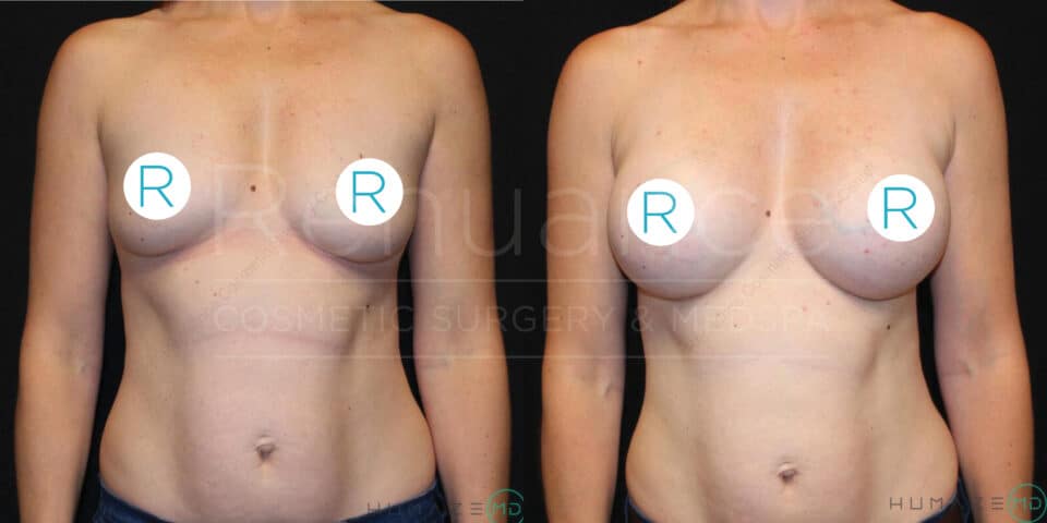 A side-by-side comparison of a woman's torso before and after breast augmentation surgery. On the left, the "before" image shows smaller breasts with a round marker labeled "R" on each breast. On the right, the "after" image shows larger, fuller breasts with similar round markers labeled "R". The woman is standing against a black background in both images. She is not wearing a top, and her midsection is visible in both images.