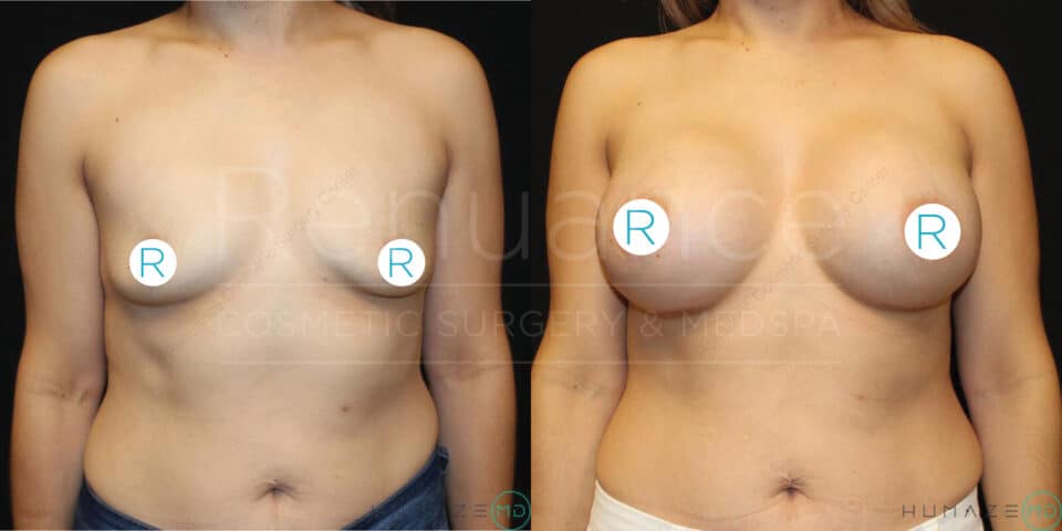 A side-by-side comparison image showing the upper torso of a woman before and after a cosmetic breast procedure. The left side (before) shows smaller, sagging breasts, while the right side (after) displays larger, uplifted breasts with increased volume. The letters "R" are placed over each breast in both images. In the background, faint text reads "Rejuve Cosmetic Surgery & Medspa".