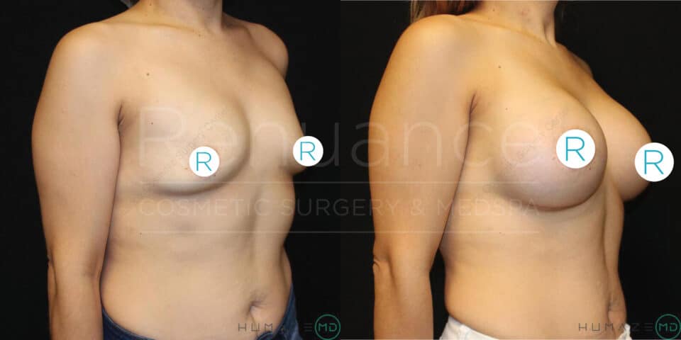Before and after side view comparison of a person's upper body, showing the results of a breast augmentation surgery. The left image displays the individual before the procedure, and the right image shows the enhanced breast size and shape post-surgery. Both images have marks indicating right from left.