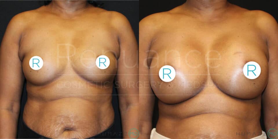 The image shows a before and after comparison of a woman's torso. The left side depicts the individual's chest and abdomen before surgery, with noticeable sagging in the breasts and excess skin on the abdomen. The right side shows the same person after surgery with fuller, elevated breasts and a more contoured abdomen. Both images have circular stickers with the letter "R" covering the nipples.