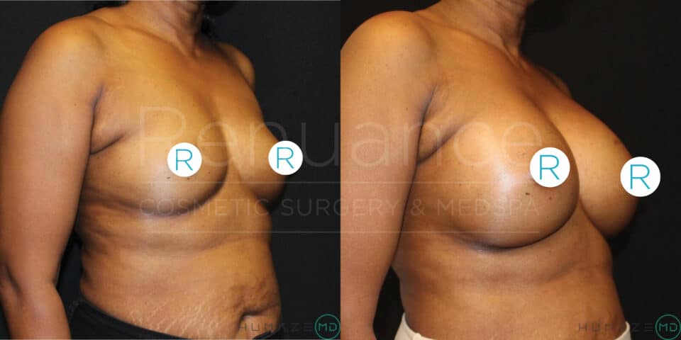 Comparison showing the left profile view of a woman's torso before and after a cosmetic breast enhancement procedure. The left image depicts the torso prior to surgery, while the right image shows the noticeable increase in breast size post-surgery.