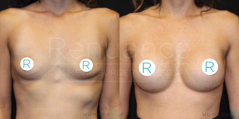 Before and after photo of a person who has undergone breast augmentation surgery. The left side shows the individual before the procedure with smaller breasts, and the right side shows the enhanced, larger breasts post-surgery. The nipples are covered with "R" labeled stickers in both images. The background is black.