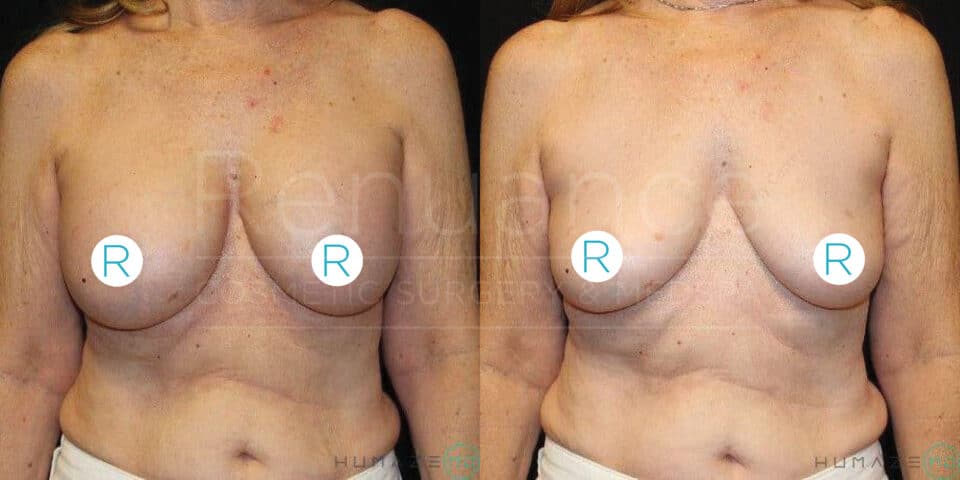 A before and after comparison of a woman’s torso showing the results of cosmetic breast surgery. The left image depicts smaller, sagging breasts. The right image shows the same woman’s breasts lifted and fuller. Both images focus on the chest and upper abdomen area.