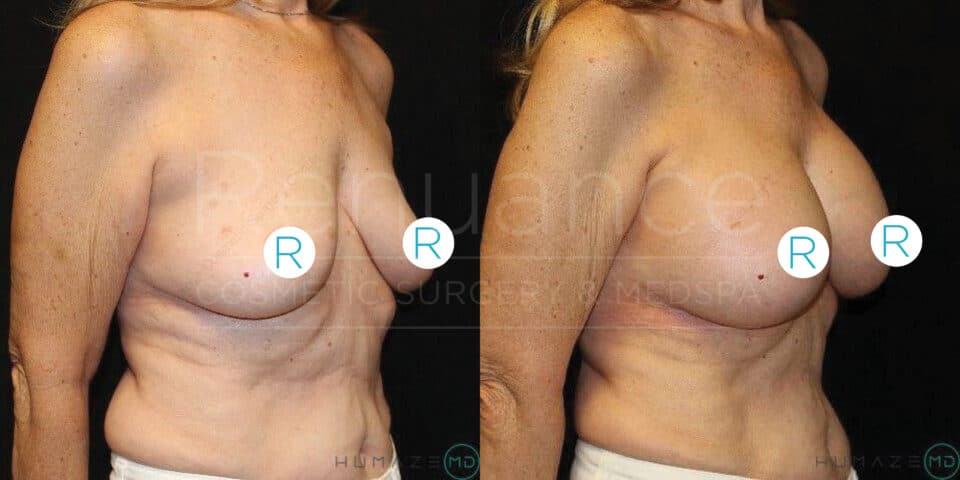 Side-by-side comparison of a woman's torso before and after a surgical procedure. The left side shows the 'before' image with sagging breasts and the right side shows the 'after' image with lifted and more symmetrical breasts. Both images have labels indicating the right breast. The woman's skin tone is fair, and her torso appears to be unclothed. The background is black.