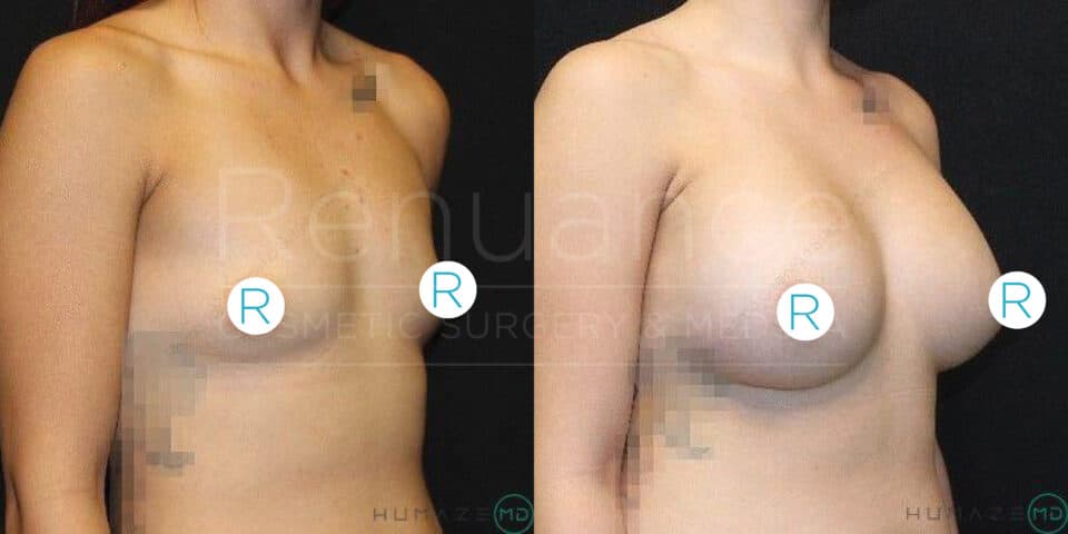 Side-by-side comparison images showing a person's torso before and after breast augmentation surgery. The left image shows the person before the procedure, while the right image displays the enhanced breast size post-surgery. Both images have certain areas covered for privacy.