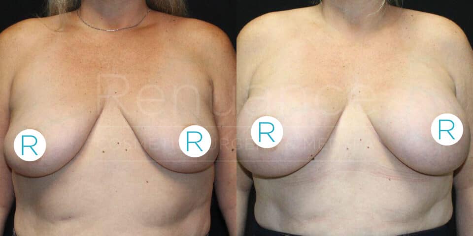 Two side-by-side images showing a woman's upper torso before and after breast surgery. Both images display her from the front, with indicators labeled "R" on her breasts. The "before" image on the left shows her breasts with noticeable sagging, while the "after" image on the right shows her breasts lifted and reshaped. The woman's face is not visible in either image.