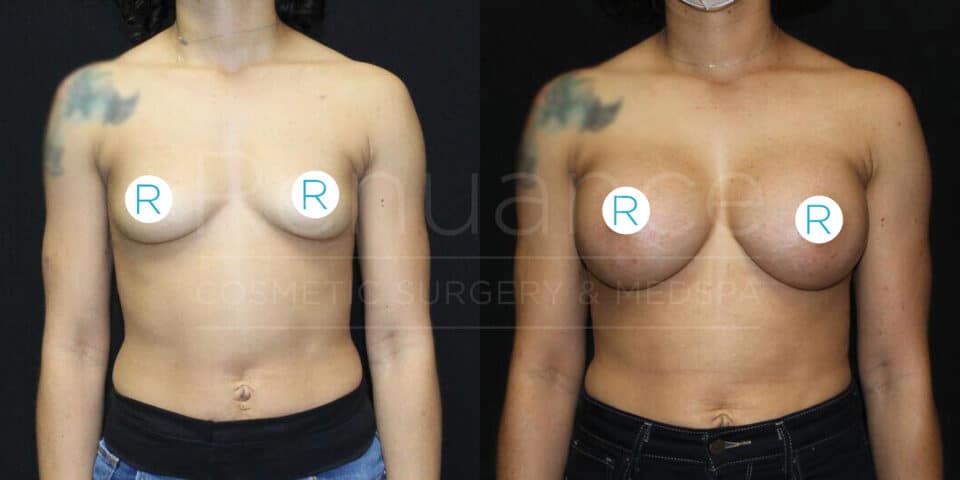A comparison image showing a person from the waist up before and after breast augmentation surgery. The left side shows the person with smaller breasts, and the right side shows the person with larger, augmented breasts. They are standing against a black background and wearing dark-colored pants.