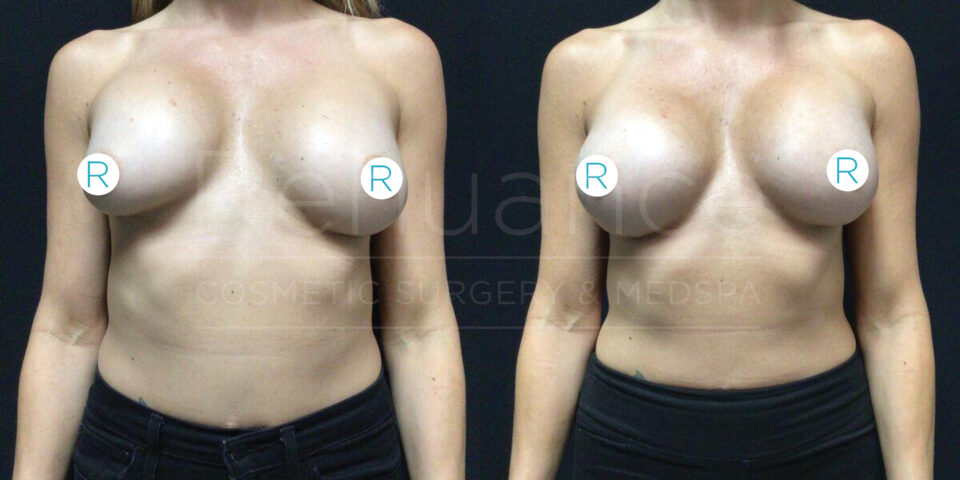 Alt text: "Comparison image of a woman’s torso before and after breast augmentation. Both images show front views with the woman wearing a bra that covers but outlines the breast implants. The 'R' labels are circled on each breast in both images."