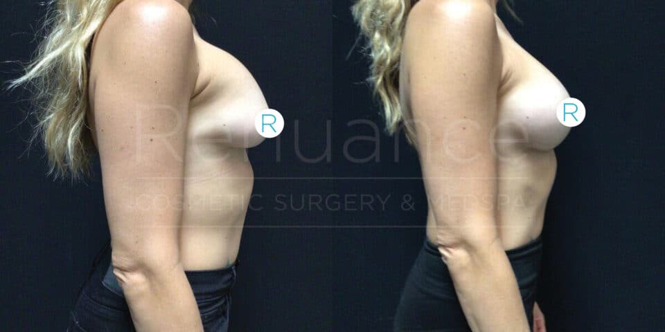 A side-by-side comparison shows the profile view of a woman's upper torso before and after a cosmetic surgery procedure. The images highlight the changes in breast size and shape. In both images, the woman has long, blonde hair and is wearing dark pants. The background is black.