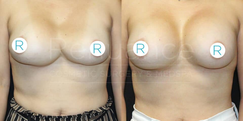 A before and after comparison image of a woman's chest, likely showcasing the results of a cosmetic surgery procedure. Both images focus on the same person, taken from the front, and feature circular stickers with the letter "R" covering the nipples for modesty. The left image represents the 'before' state, and the right image represents the 'after' state. The background is dark, highlighting the subject. The logo of a cosmetic surgery and medspa clinic is faintly visible in the center of the