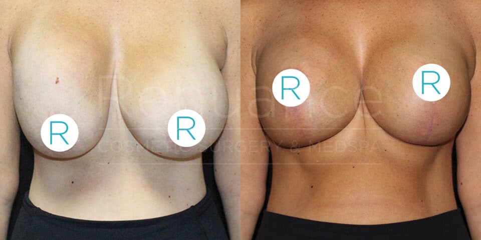 Before and after comparison of a person who has undergone breast augmentation surgery. The left side displays pre-surgery, with natural breasts and less symmetry. The right side shows post-surgery with fuller and more symmetrical breasts. 

