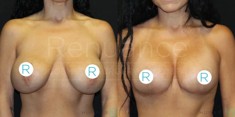 A side-by-side comparison photo of a woman's breasts before and after a cosmetic surgery procedure. The left image shows the "before" state where the breasts appear larger and more outward. The right image shows the "after" state with smaller and more lifted breasts. The images have circular white labels marked "R" over each breast and watermarks that include text such as "Renue . . .", "Cosmetic Surgery Med Spa", and "Humanze". The woman's torso is shown in both images