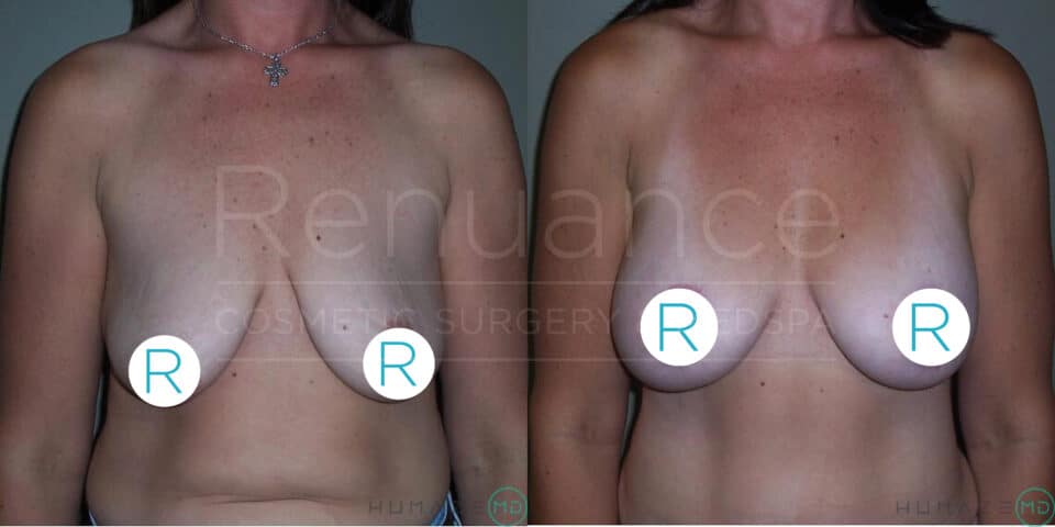 The image shows a split-screen of a woman's torso before and after breast lift surgery. The left side displays the "before" image, showing sagging breasts. The right side features the "after" image, showing the breasts lifted and more contoured. The nipples of both images are covered with circle stickers marked with the letter "R." The woman wears a necklace in both images. The background has a watermark reading "Renuance Cosmetic Surgery & Med Spa."