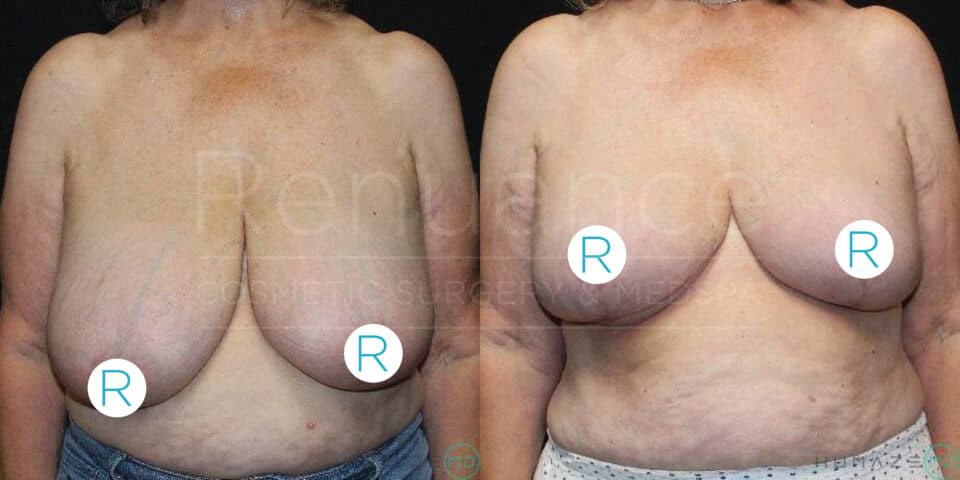 Before and after images of a person who has undergone breast reduction surgery. The left side shows the person before the surgery with larger, sagging breasts. The right side shows the person after the surgery with smaller, lifted breasts. The images are labeled with the letter "R." Both images are taken against a dark background.