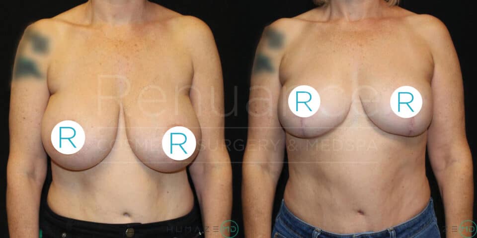 A before-and-after image depicts two women from the chest up, showcasing the results of a cosmetic breast procedure. The woman on the left has larger, sagging breasts, while the woman on the right appears post-surgery with lifted, smaller breasts. Both women have their nipples covered with circles marked with the letter 'R'. The text "Renuance Cosmetic Surgery & MedSpa" is faintly visible in the background.