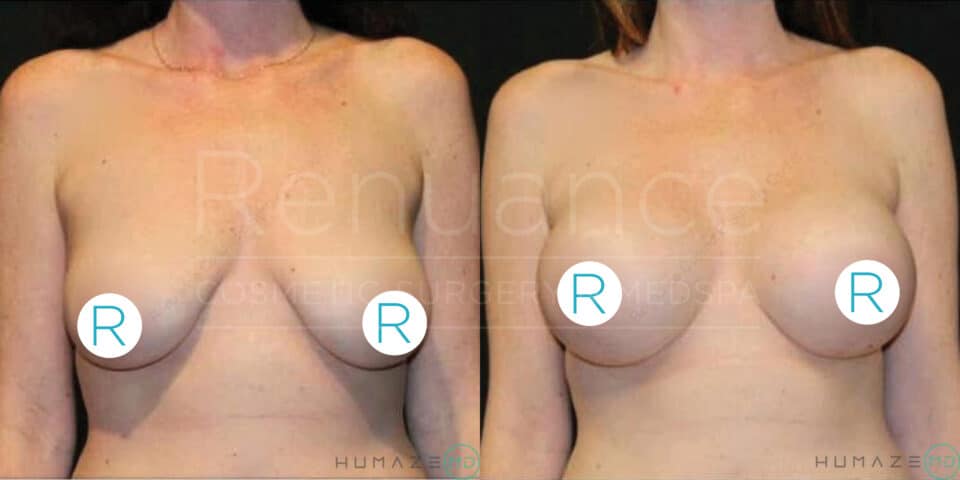 "Before and after comparison image of a woman who has undergone breast augmentation surgery. On the left is the image of the woman's chest before the procedure, showing smaller breasts with a natural shape. On the right is the after image, displaying larger, fuller, and more rounded breasts. The background is dark and the words 'Renaissance Cosmetic Surgery MedSpa' and 'Humaze' are faintly visible."