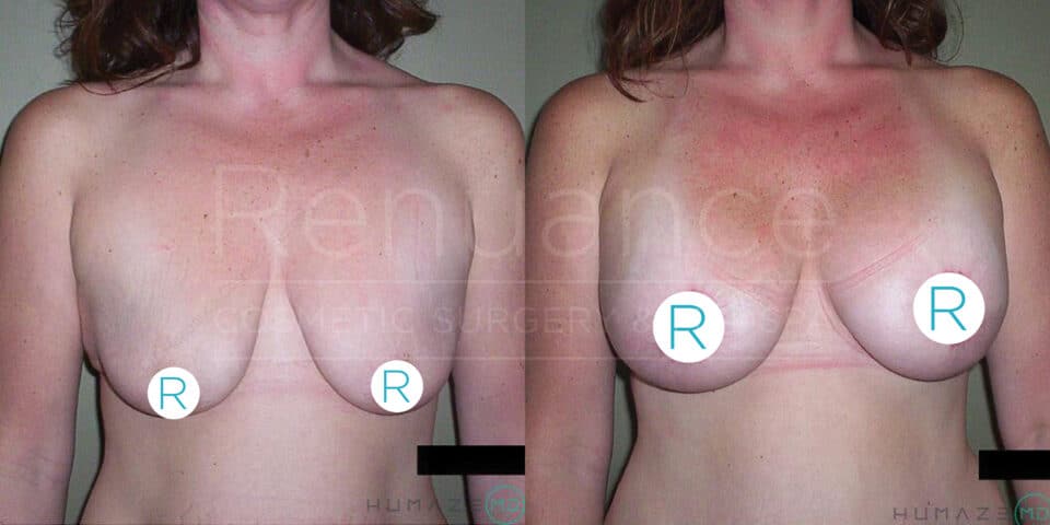 Side-by-side comparison of two photos showing the results of a breast lift surgery. The left image shows a woman with sagging breasts before the surgery, while the right image shows the same woman with uplifted, firmer breasts after the surgery. The images are labeled with "R" markers to indicate the right breast for reference.