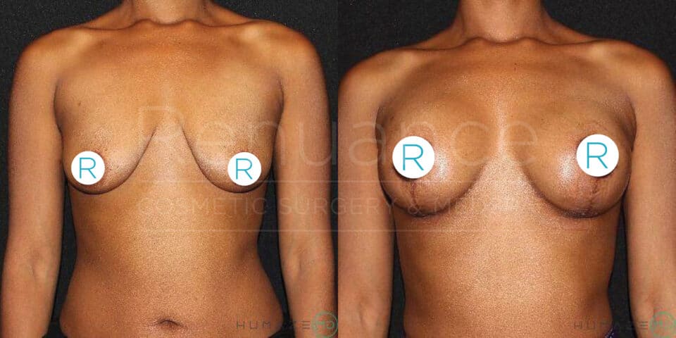 Side-by-side comparison of a person's torso before and after undergoing breast augmentation surgery. The left side shows the body before surgery, while the right side shows the body after the procedure, with visibly fuller and lifted breasts. Each image has circular labels with the letter "R" covering part of the chest area.