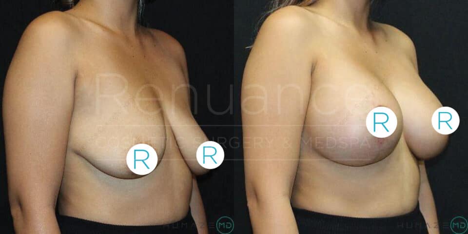 Side-by-side comparison of a woman's torso, showing the results of a breast augmentation surgery. The left image displays the "before" condition, and the right image shows the "after" condition. Each image has a circular icon with the letter "R" placed over each breast. The background is black.