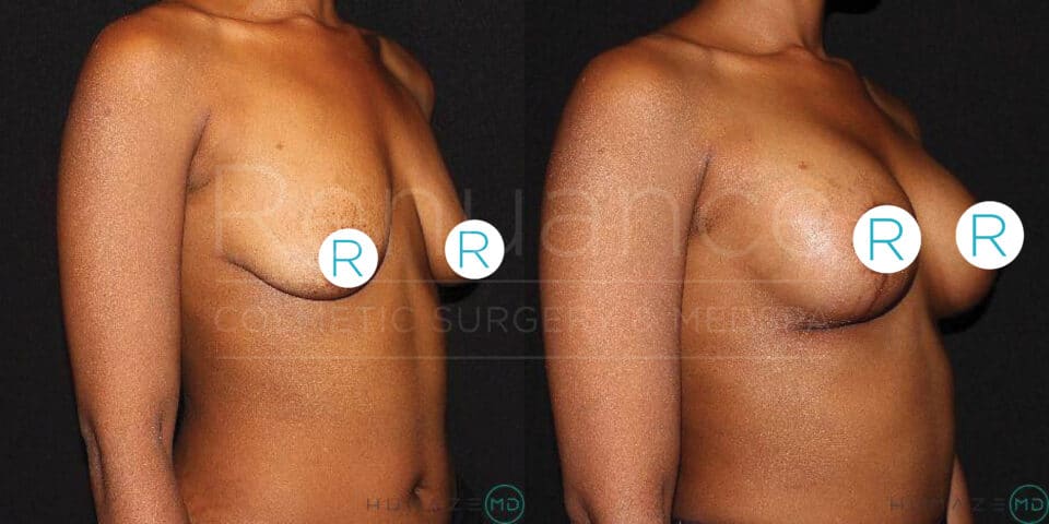 A side-by-side comparison image showing a woman's torso before (left) and after (right) undergoing a breast augmentation procedure. The image demonstrates the change in breast size and shape. The patient has brown skin, and the nipples are covered with "R" symbols for privacy. The background is dark, and there is faint text overlay in the center of the image, indicating the name of a cosmetic surgery practice and a doctor's name.