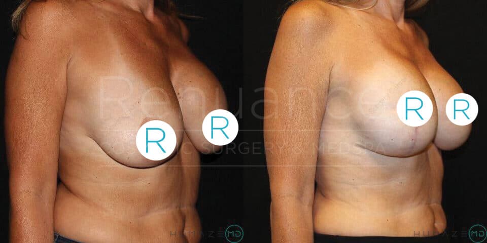 Side-by-side before and after images show a woman's torso, focusing on the chest area. The left image shows the torso before a surgical procedure, with noticeable sagging in the breasts. The right image shows the torso after the procedure, with the breasts appearing lifted and more symmetrical. The nipples are covered with circular labels marked with the letter "R." The background is dark.