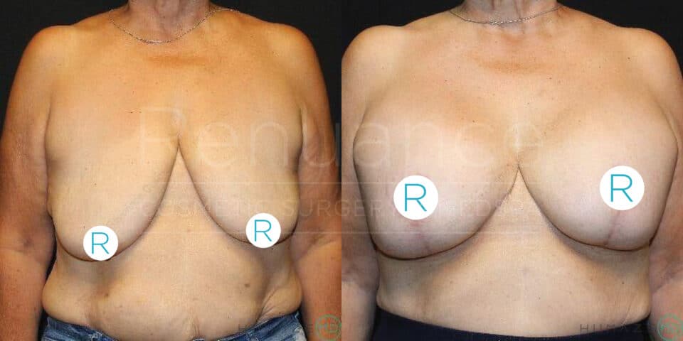 A side-by-side comparison of a person's chest before and after breast augmentation surgery. The left image shows the chest before the procedure, while the right image shows the chest after the procedure, with visibly fuller and lifted breasts. Both images have the letters "R" on the chest area, presumably to indicate "right" side. The person's face is not visible in either image.