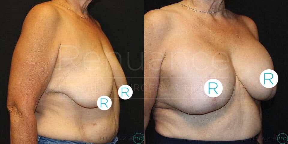 Two side-by-side images show the same individual from the torso up. The left image is a before photo, showing the person with sagging breasts and loose skin. The right image is an after photo, depicting the person post-surgery with firm, lifted breasts. Both images have a watermark that says "Renuance." Circular stickers labeled "R" cover the nipples for obscurity.