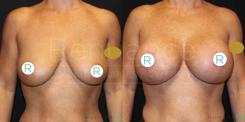The image shows a before-and-after comparison of a female torso following breast augmentation surgery. The left side depicts the pre-surgery state with noticeably smaller and sagging breasts, while the right side illustrates the post-surgery results with fuller and lifted breasts. The surgical transformation highlights a significant increase in volume and change in breast shape.