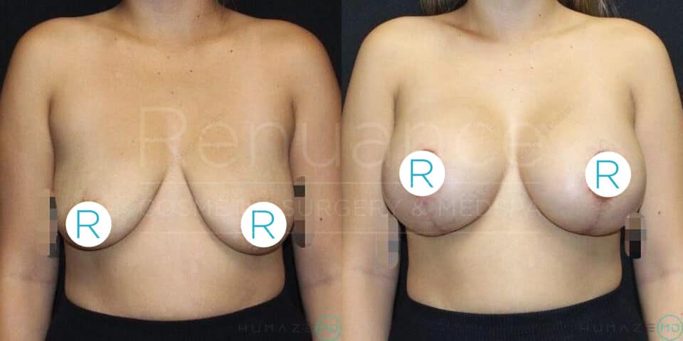 A side-by-side before and after image of a person who has undergone breast enhancement surgery. The person is standing topless and facing the camera in both images. The image on the left shows the person before the surgery, with noticeably smaller breasts. The image on the right shows the results after the surgery, with a significant increase in breast size and lift. The nipples in both images are covered with circular "R" labels for privacy.