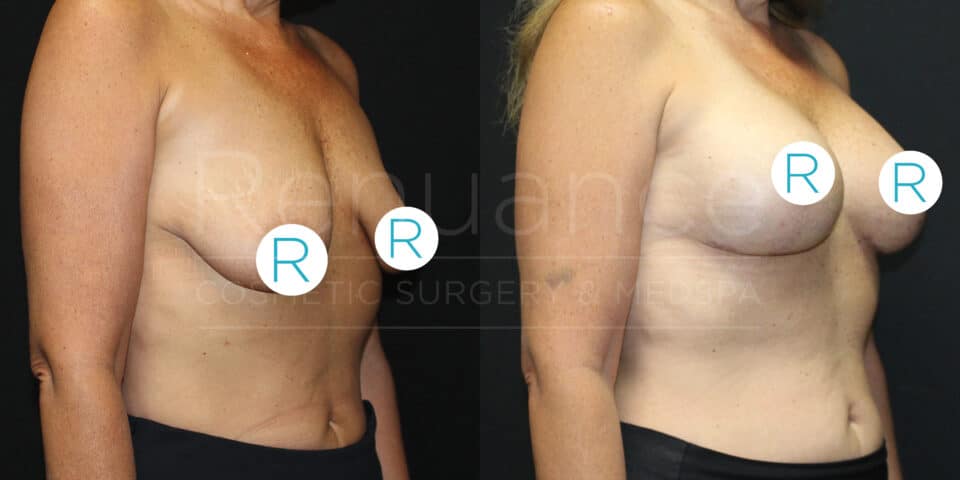 Side-by-side comparison of a woman's torso before and after breast augmentation surgery. On the left, the woman has noticeably smaller breasts, while on the right, her breasts appear larger and fuller. The image is from a cosmetic surgery and medspa.