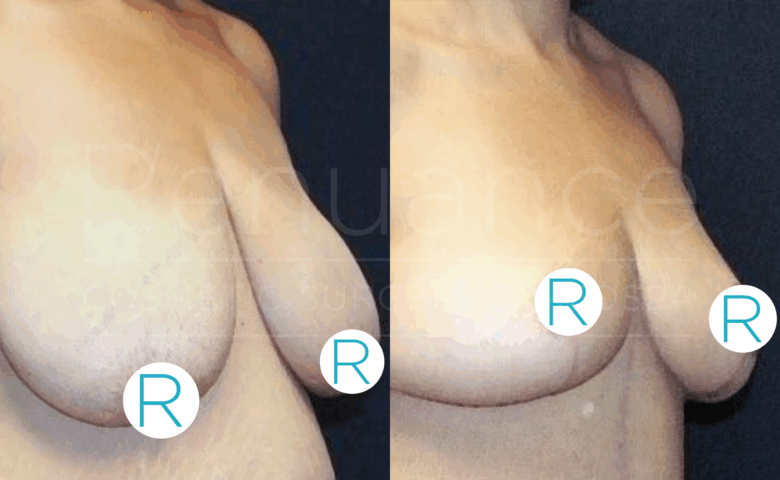 A side-by-side comparison photograph showing the results of a breast augmentation or lift procedure. The left side image shows the person's breasts before the procedure, while the right side image displays the results after the procedure, with visibly lifted and reshaped breasts. The images are labeled with the letter "R" on each breast, signifying "Right."
