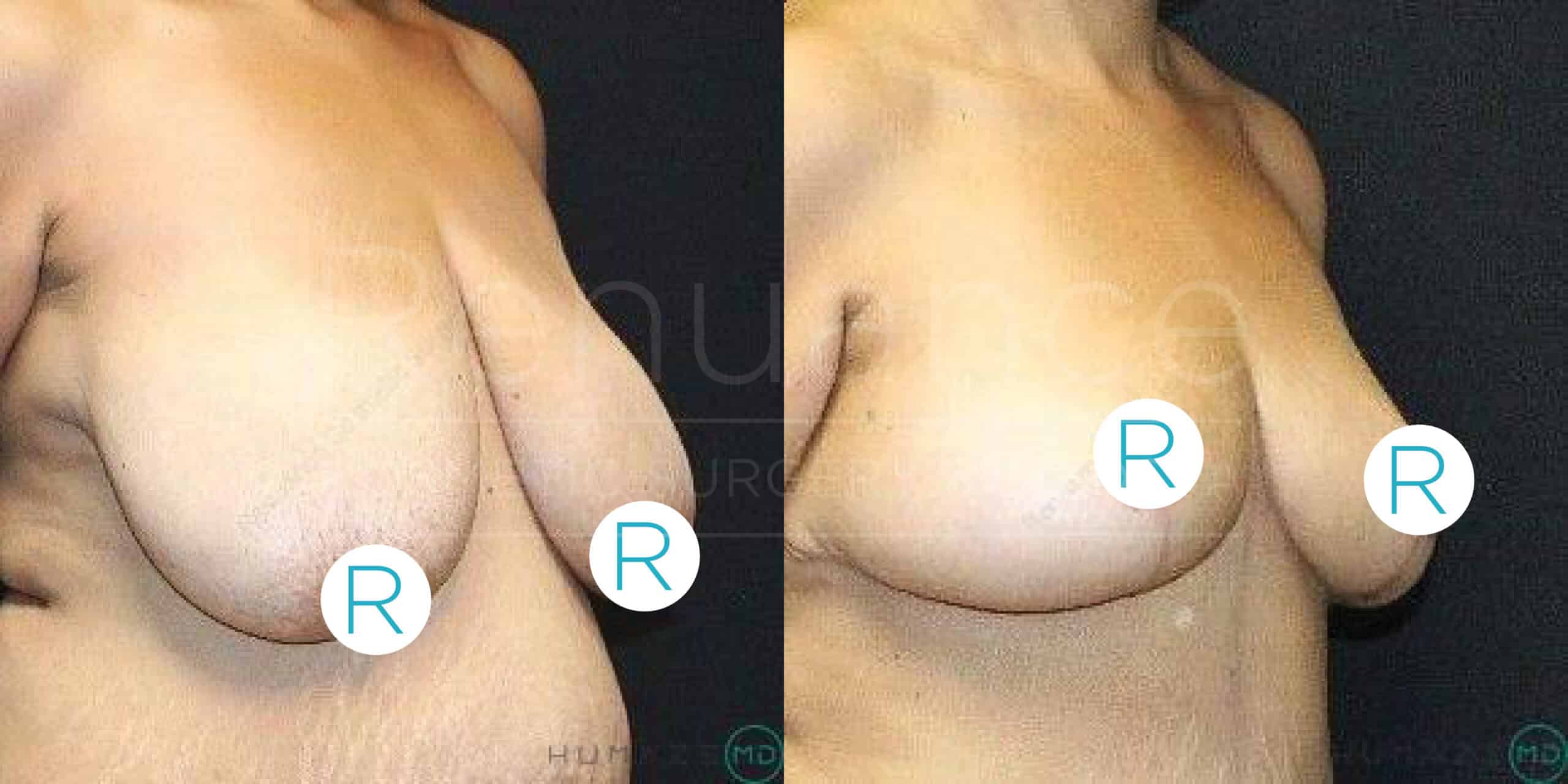 Before and after comparison of a person's torso showcasing the results of a breast reduction surgery. The image on the left shows the person's breasts before the surgery, appearing larger and sagging. The image on the right shows the person's breasts after the surgery, appearing smaller and lifted. Each breast is marked with an "R" symbol. The background is dark, highlighting the changes in the person's body.